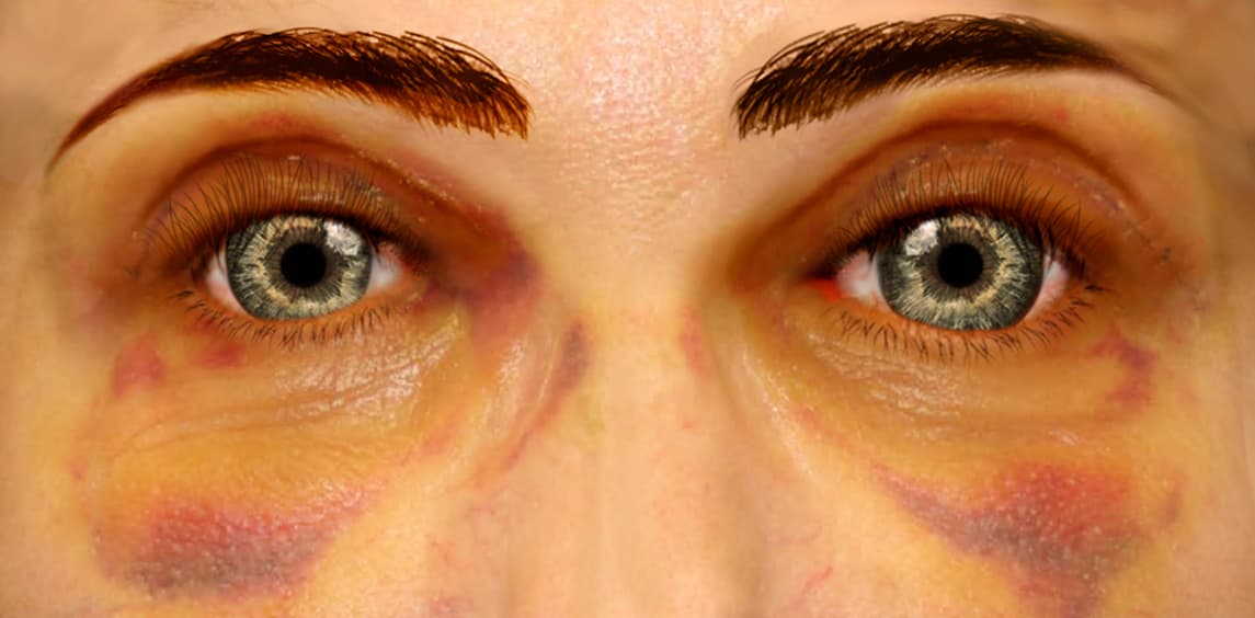 Upper blepharoplasty recovery at 3 weeks