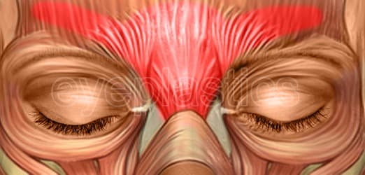 Standard botulinum toxin injection sites diagram