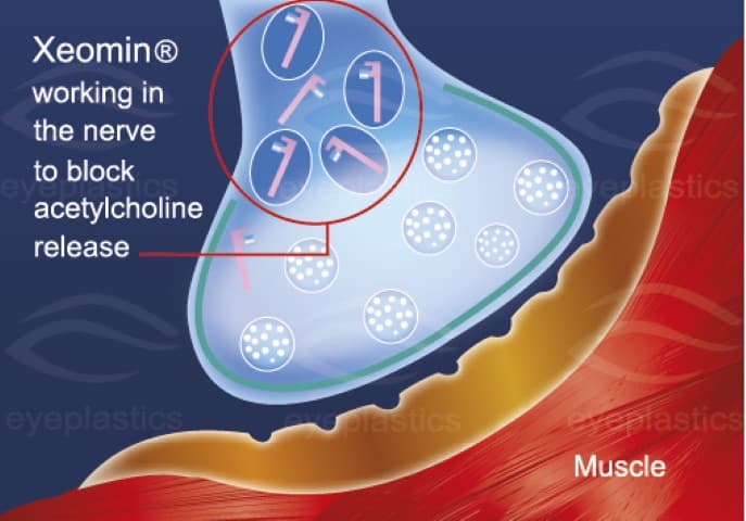 Xeomin — naked toxin, no accessory proteins