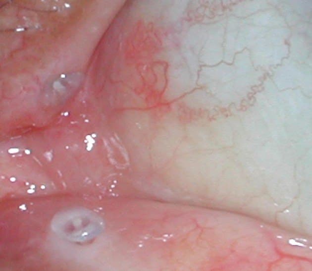Punctal plugs in both the upper and lower puncta