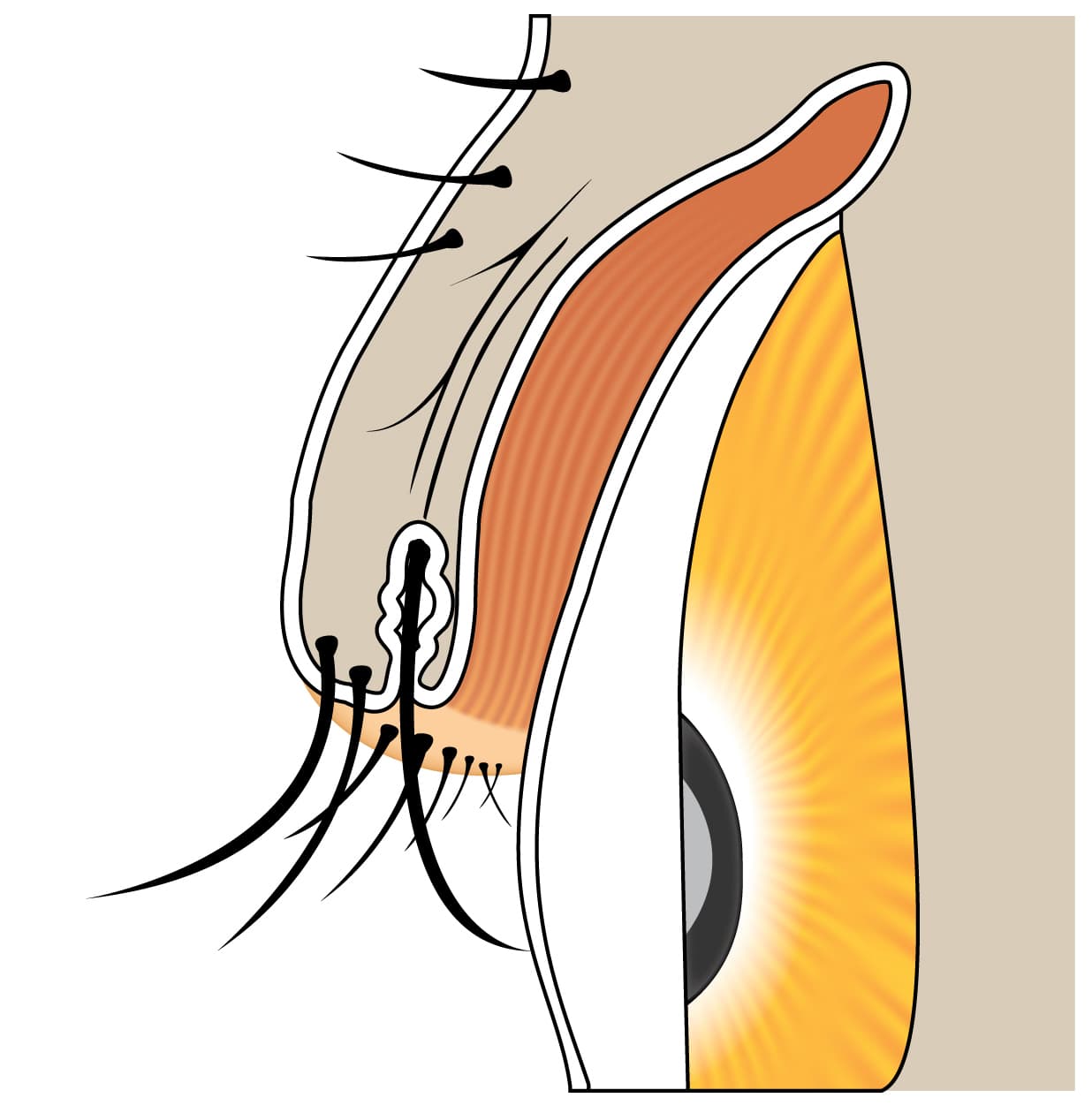 Clinical photograph of distichiasis