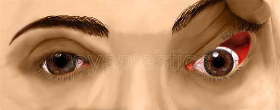 Floppy eyelid syndrome &mdash; easily everted upper eyelid
