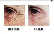 Laser skin rejuvenation result 3