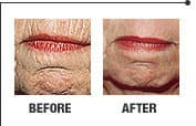 Laser skin rejuvenation result 6