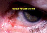Eyelid skin tumor