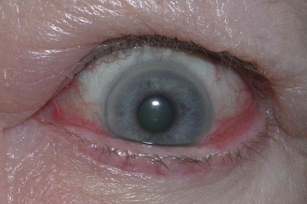 Conjunctival injection and chemosis in active thyroid eye disease