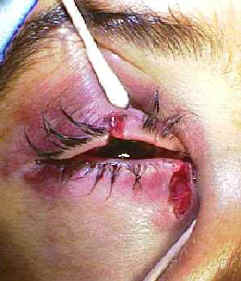 Silicone stent intubation for canalicular repair