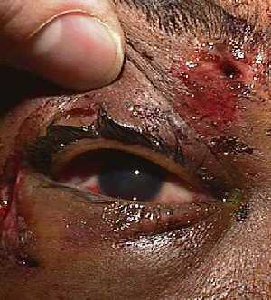 Complex eyelid laceration